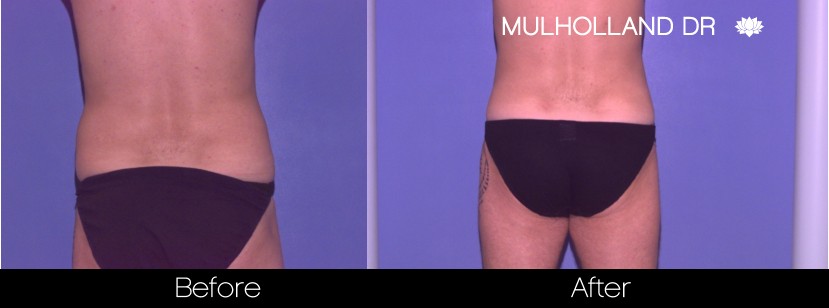 Liposuction - Before and After Gallery – Photo 78