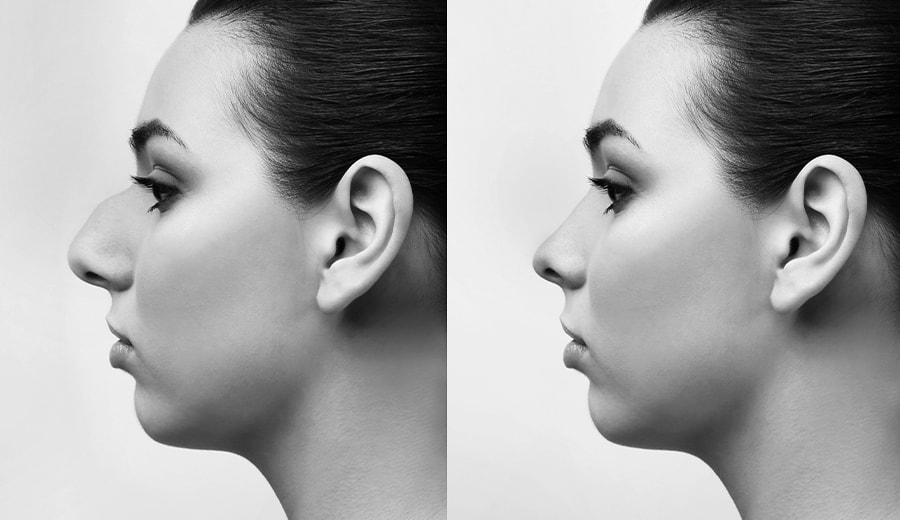 left profile view of before and after rhinoplasty