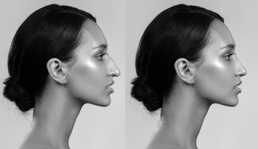 right profile view of before and after rhinoplasty