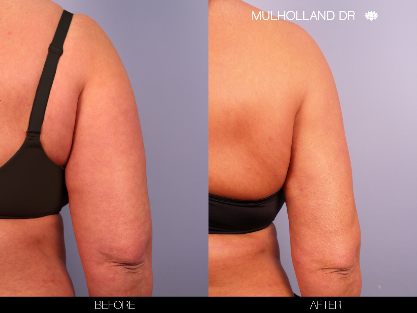 Arm Lift - Before and After Gallery – Photo 10