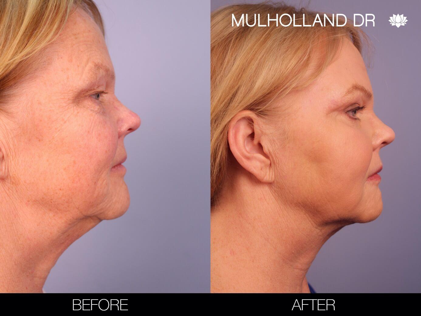 ThreadLift - Before and After Gallery – Photo 9