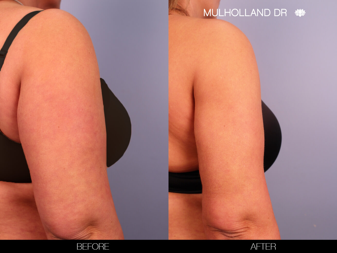 Arm Lift - Before and After Gallery – Photo 11