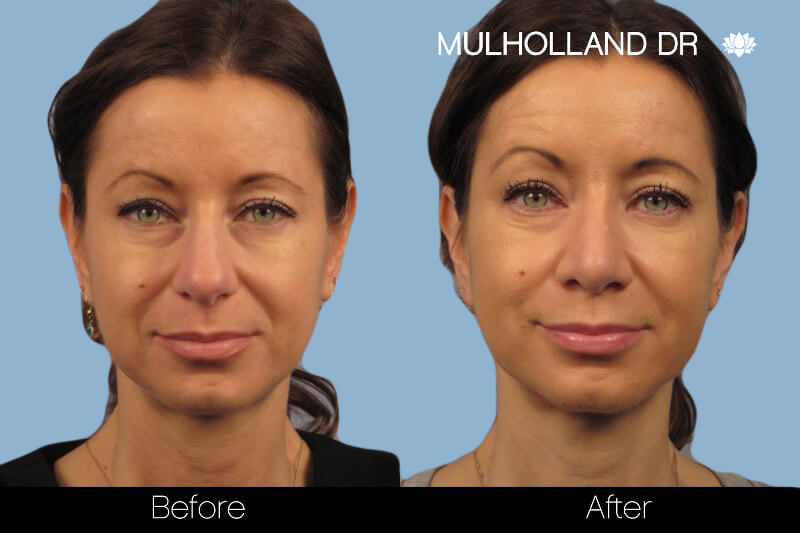 Rhinoplasty - Before and After Gallery – Photo 11
