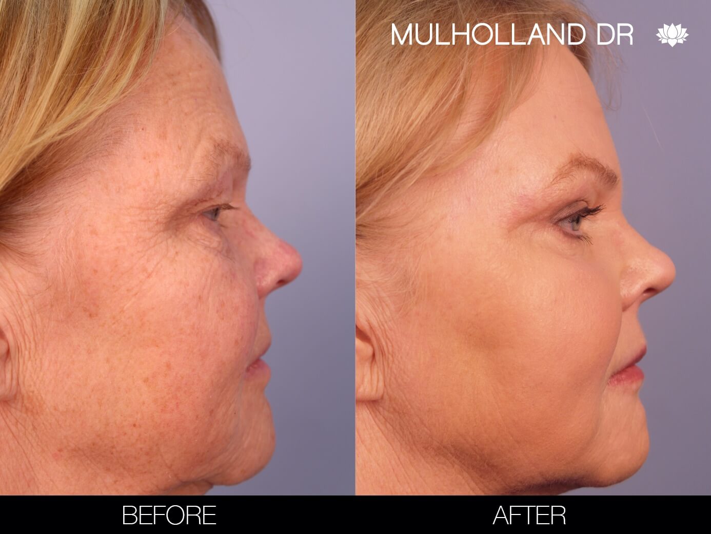 ThreadLift - Before and After Gallery – Photo 10