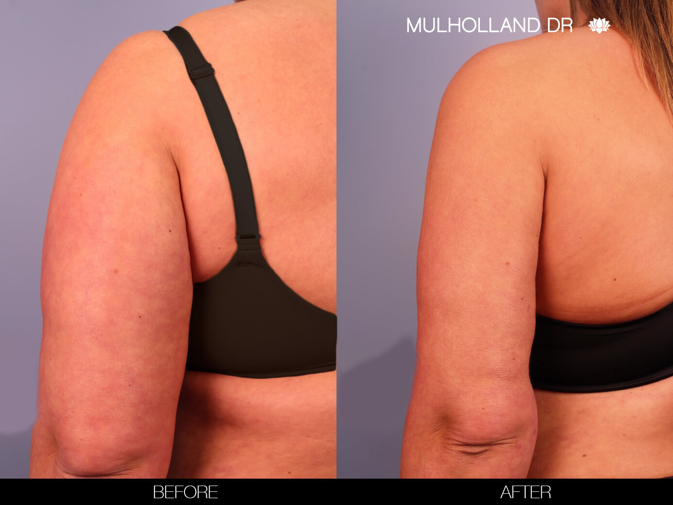 Arm Lift - Before and After Gallery – Photo 12