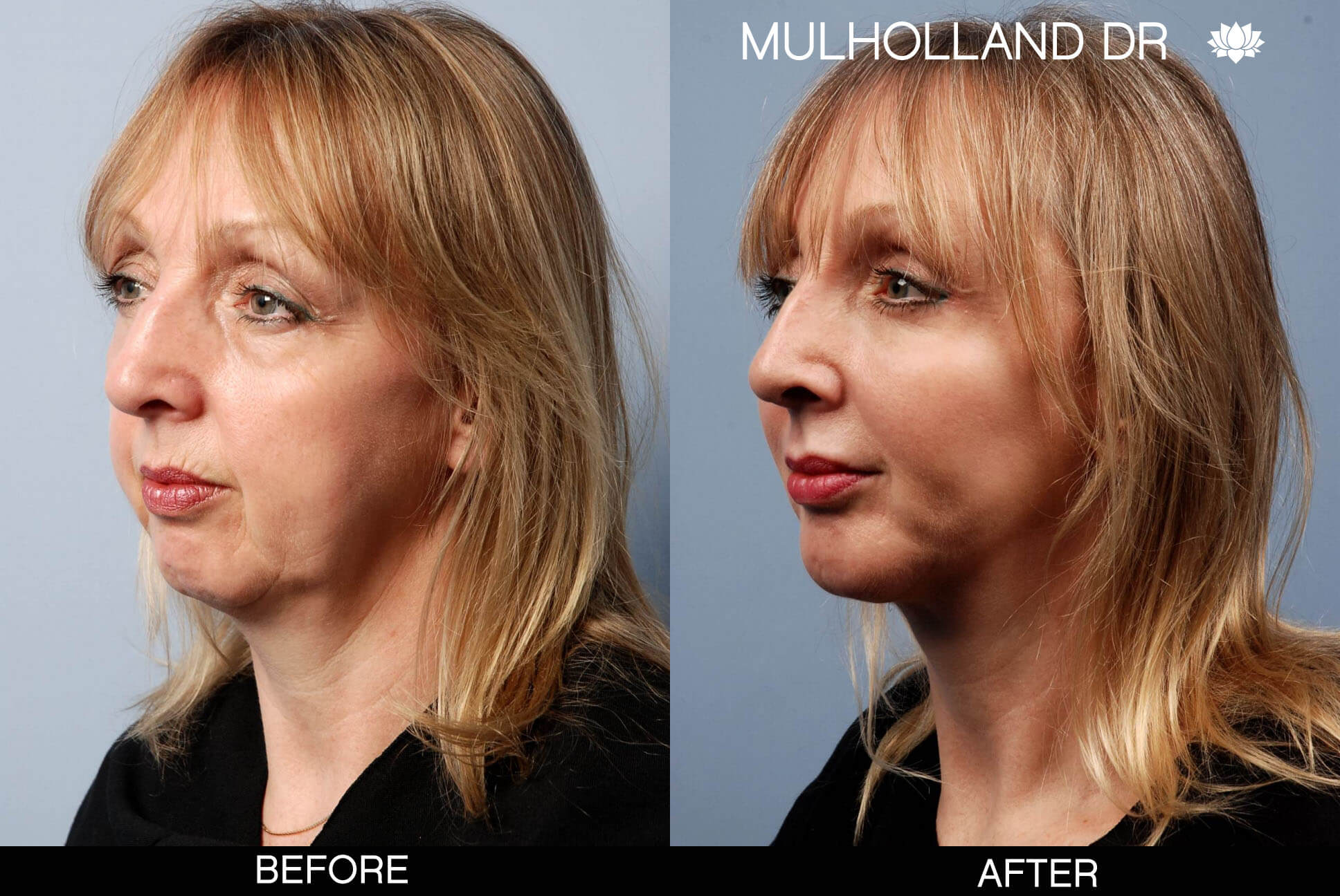 Facelift - Before and After Gallery – Photo 12
