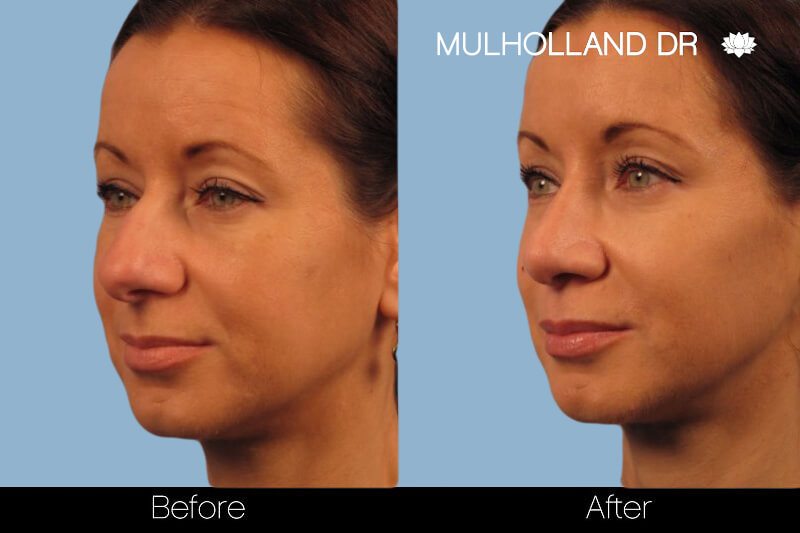 Rhinoplasty - Before and After Gallery – Photo 12