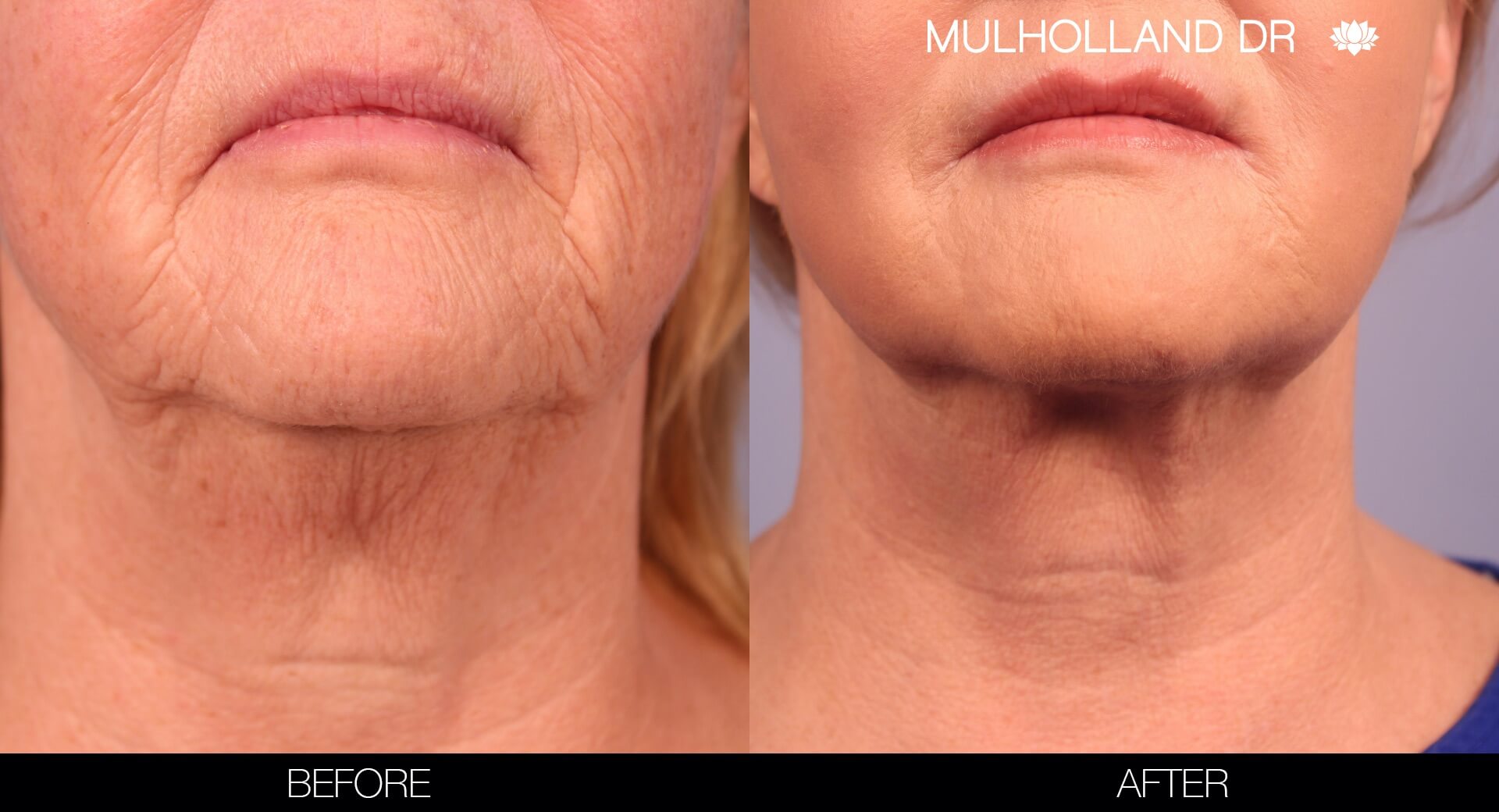 ThreadLift - Before and After Gallery – Photo 11