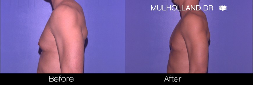 Male Liposuction - Before and After Gallery – Photo 12