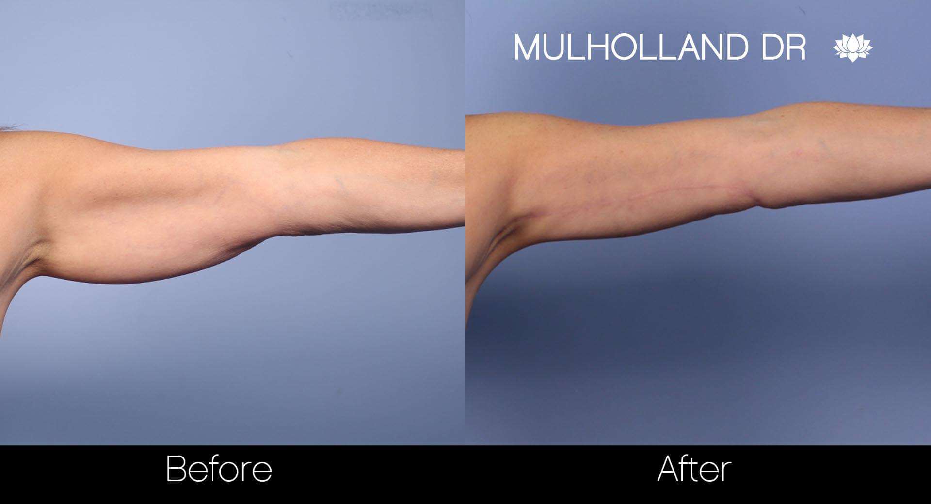 Arm Lift - Before and After Gallery – Photo 13