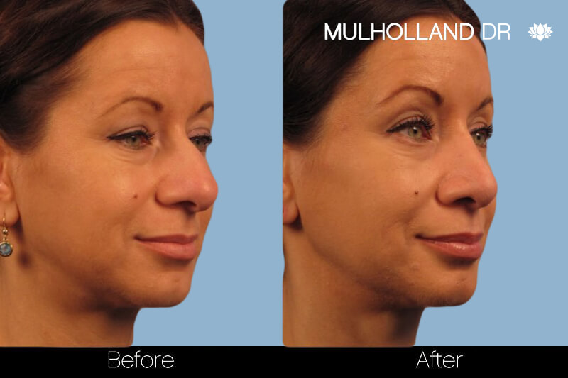 Rhinoplasty - Before and After Gallery – Photo 13