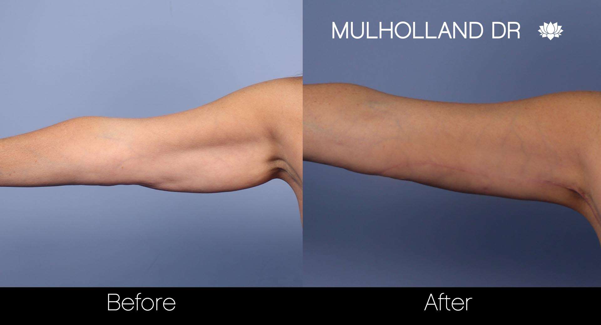 Arm Lift - Before and After Gallery – Photo 14