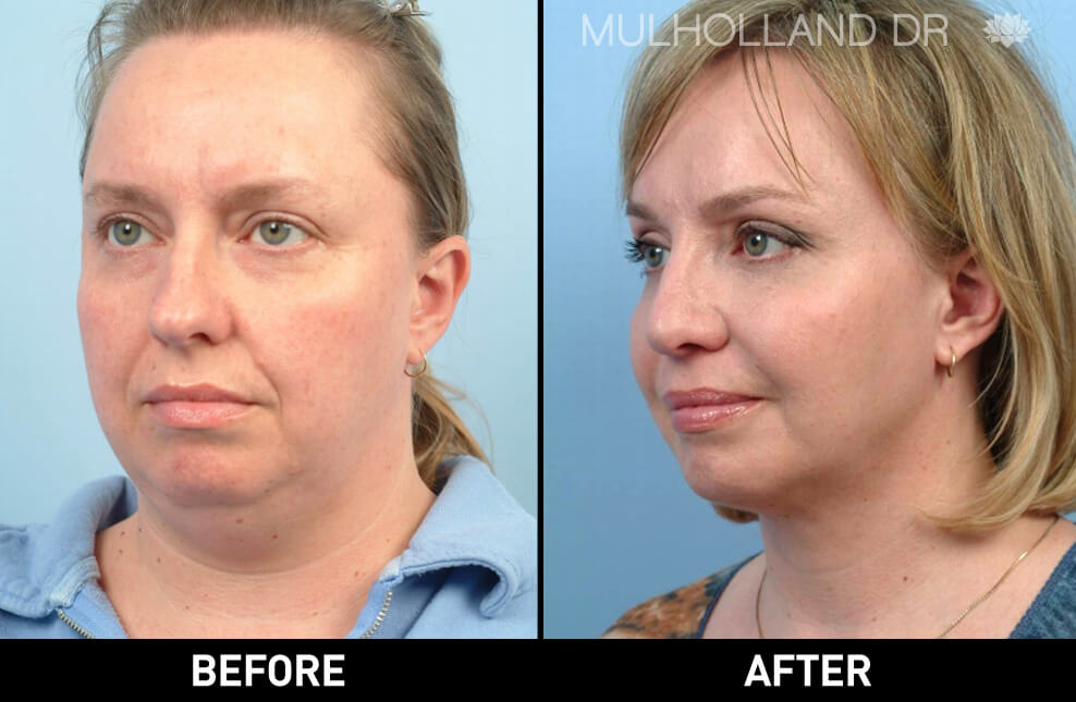 Facelift - Before and After Gallery – Photo 14