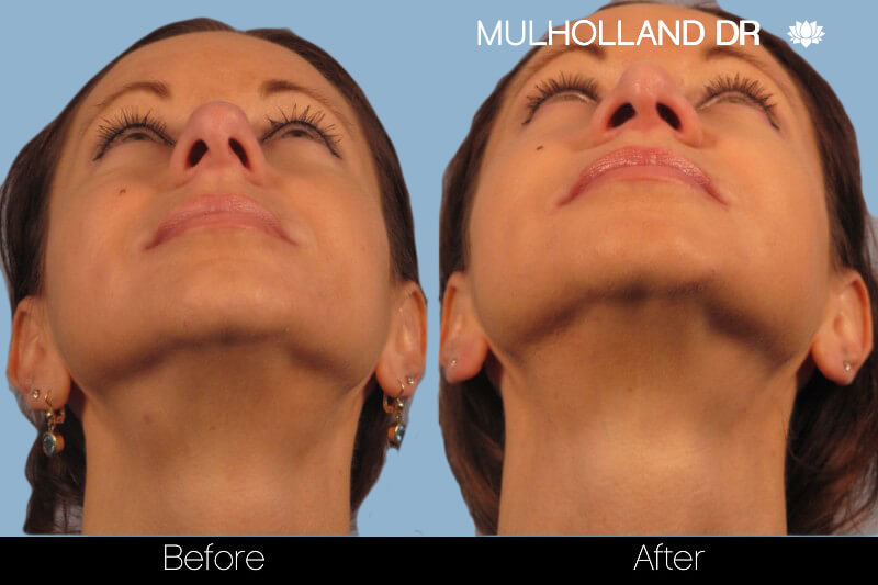 Rhinoplasty - Before and After Gallery – Photo 14