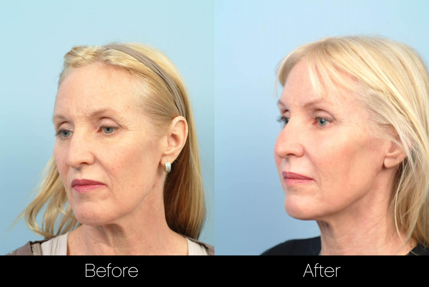 ThreadLift - Before and After Gallery – Photo 13