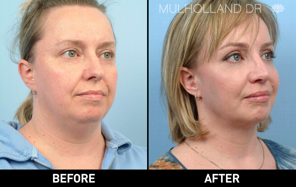 Facelift - Before and After Gallery – Photo 15