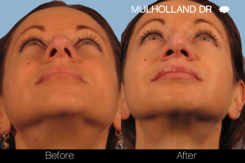 Rhinoplasty - Before and After Gallery – Photo 15
