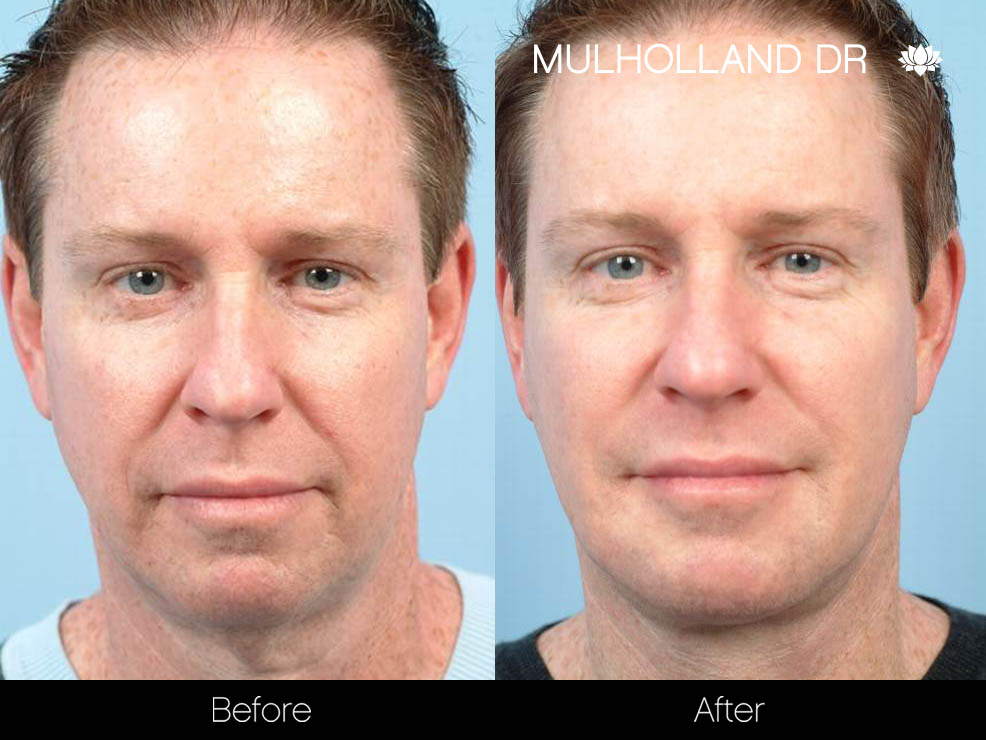 Male Liposuction - Before and After Gallery – Photo 15