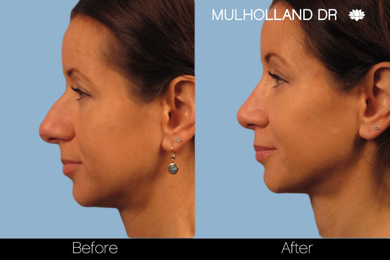 Rhinoplasty - Before and After Gallery – Photo 16