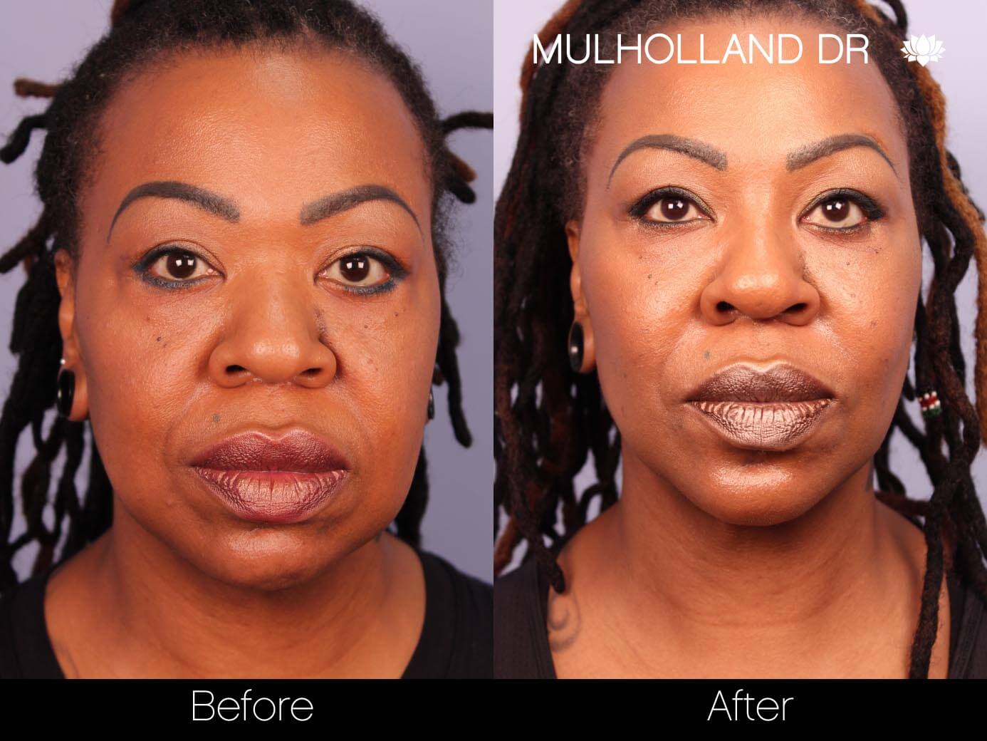 ThreadLift - Before and After Gallery – Photo 14