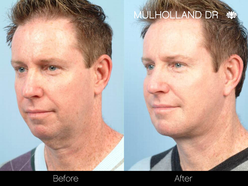 Male Liposuction - Before and After Gallery – Photo 16
