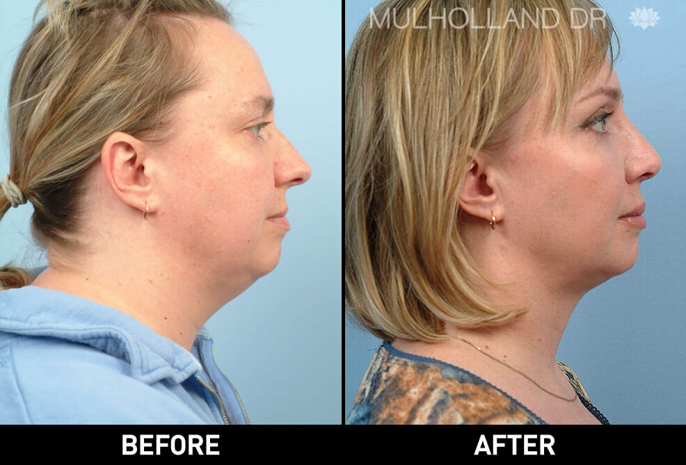 Facelift - Before and After Gallery – Photo 17