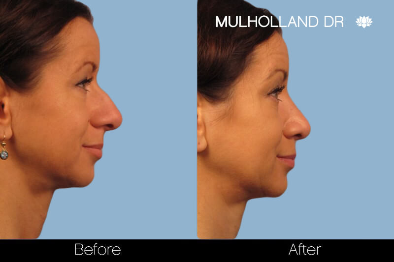Rhinoplasty - Before and After Gallery – Photo 17