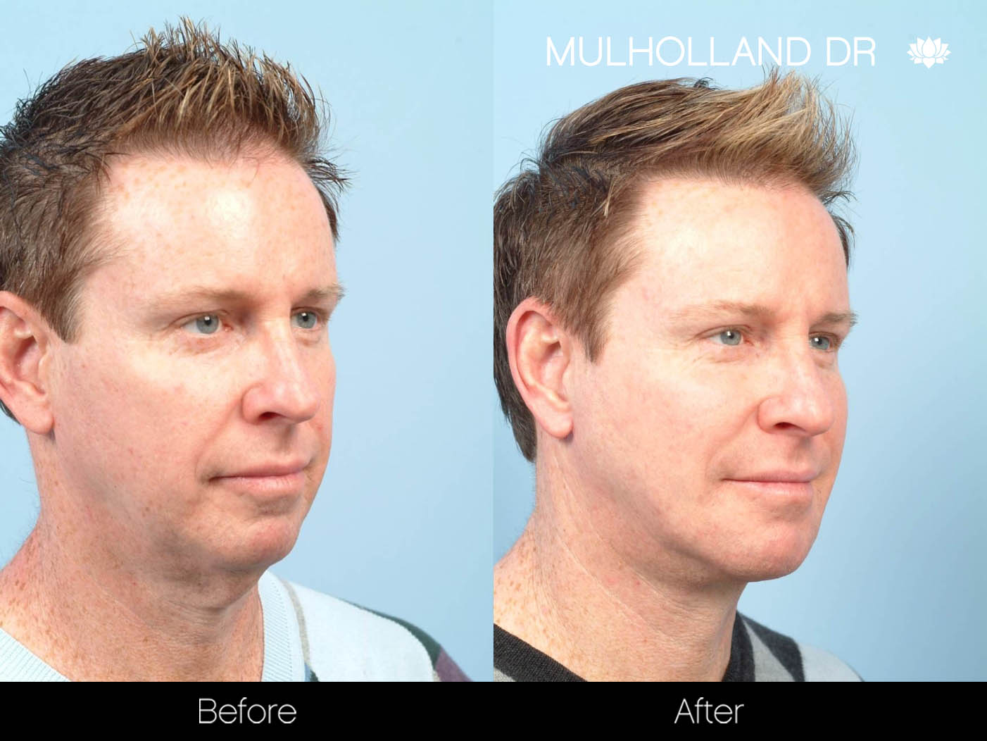 Male Liposuction - Before and After Gallery – Photo 17