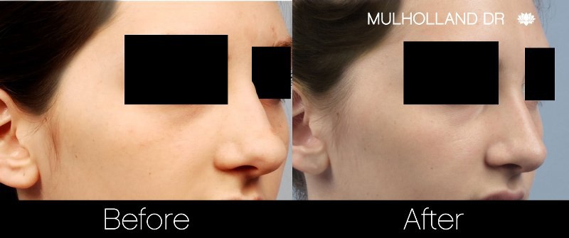 Rhinoplasty - Before and After Gallery – Photo 18