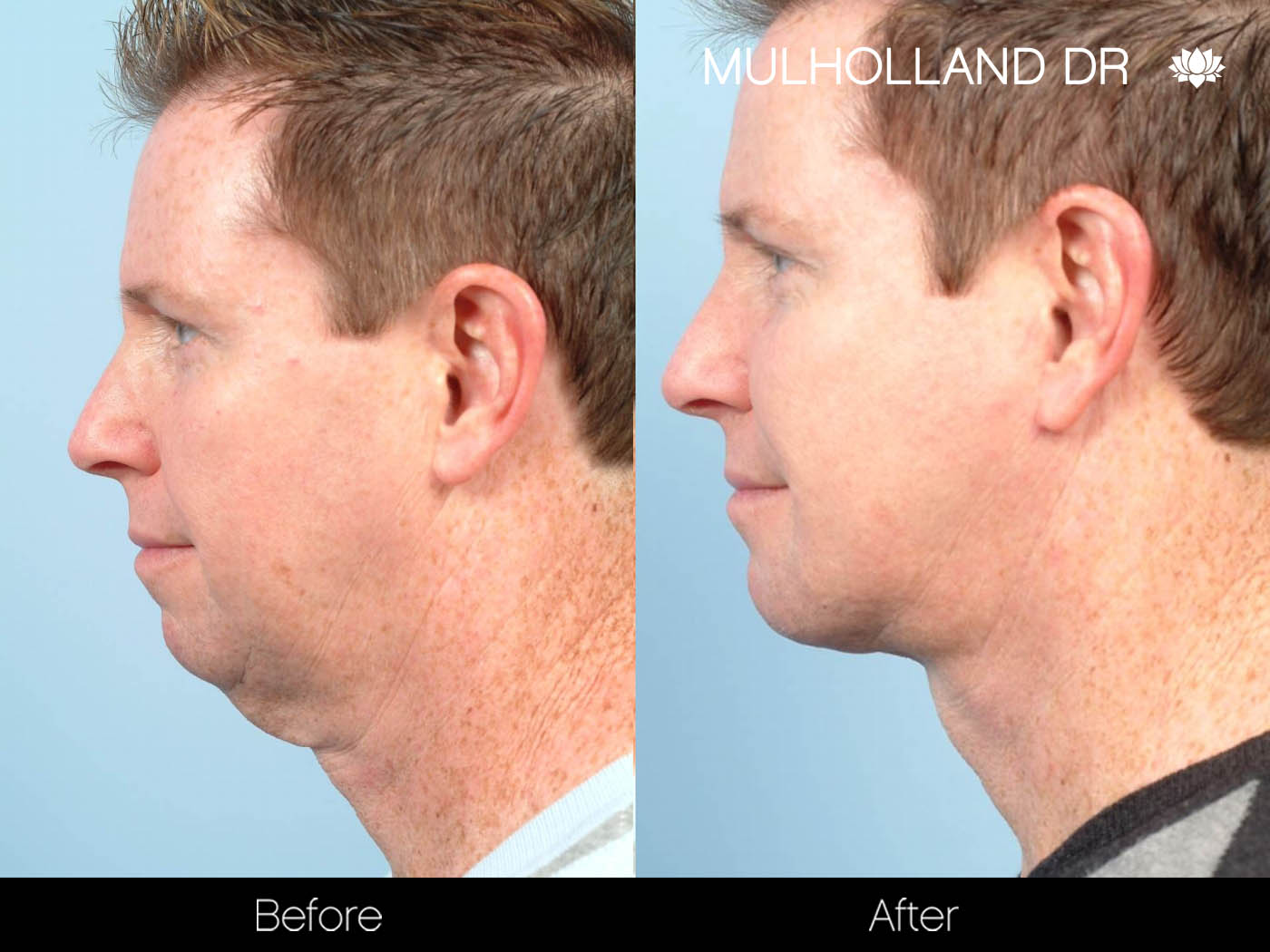 Male Liposuction - Before and After Gallery – Photo 18