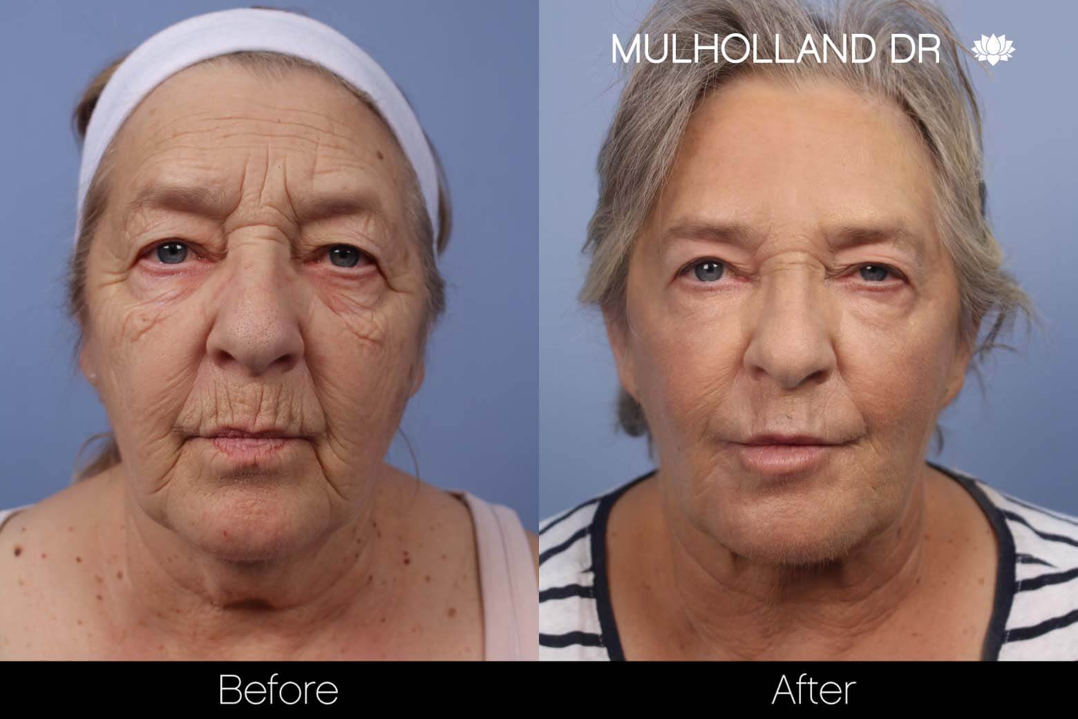 Facelift - Before and After Gallery – Photo 19