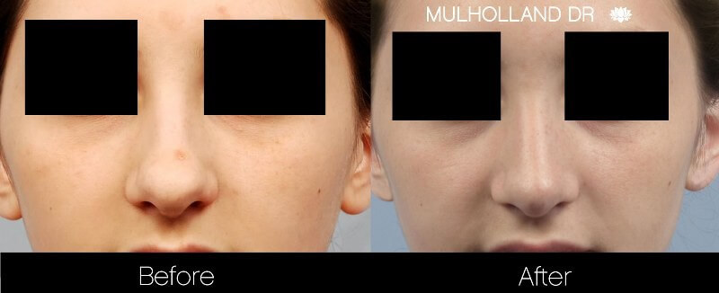 Rhinoplasty - Before and After Gallery – Photo 19