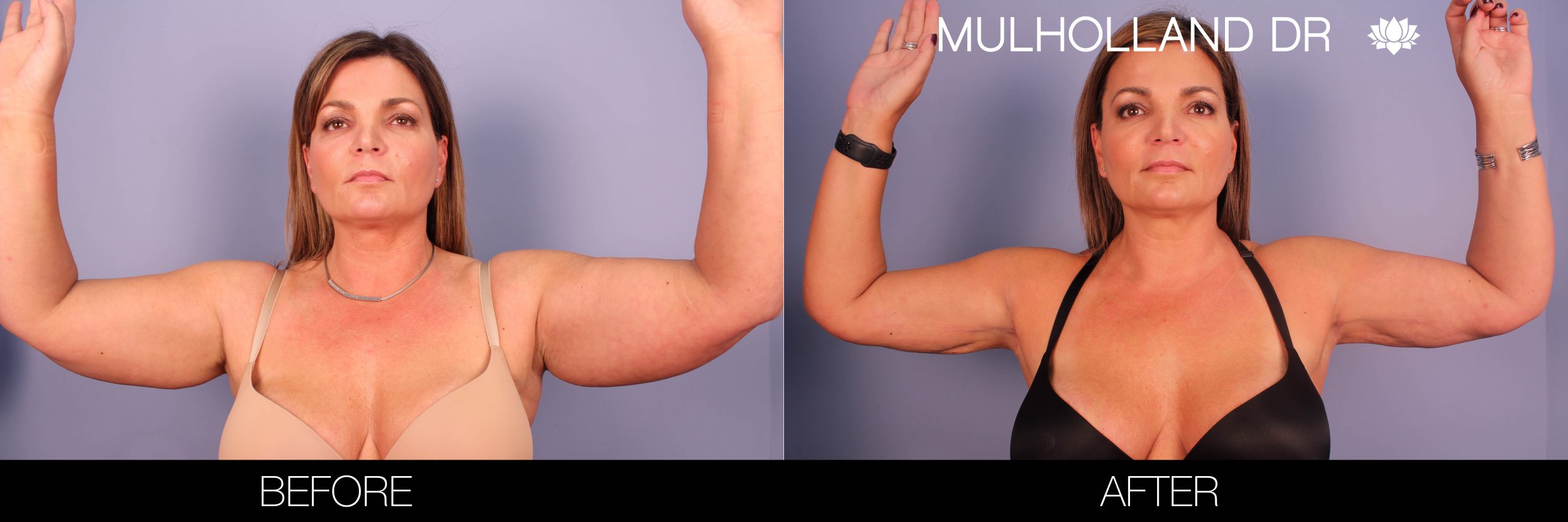Arm Lift - Before and After Gallery – Photo 1