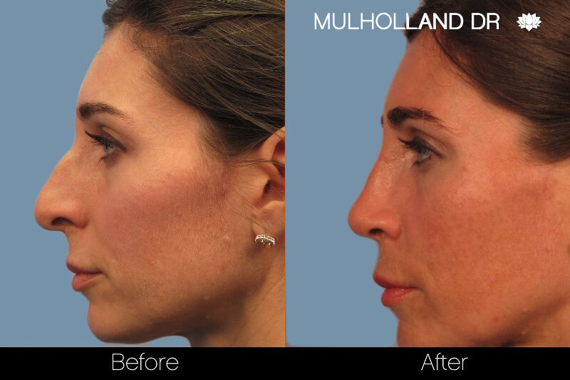 Rhinoplasty - Before and After Gallery – Photo 1