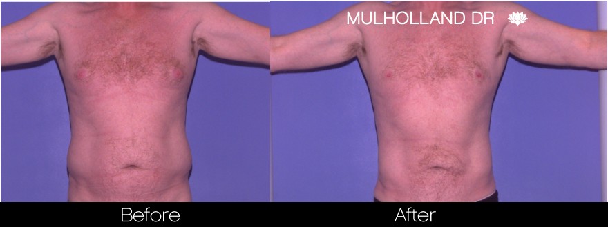 Male Liposuction - Before and After Gallery – Photo 6