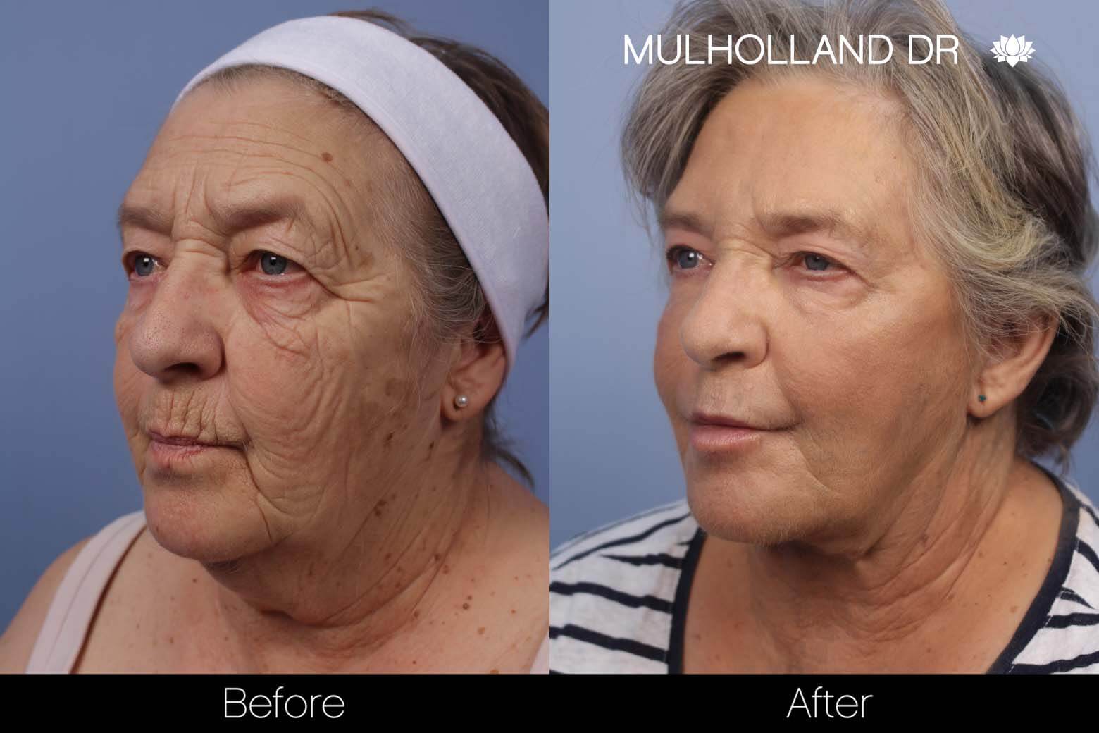 Facelift - Before and After Gallery – Photo 20