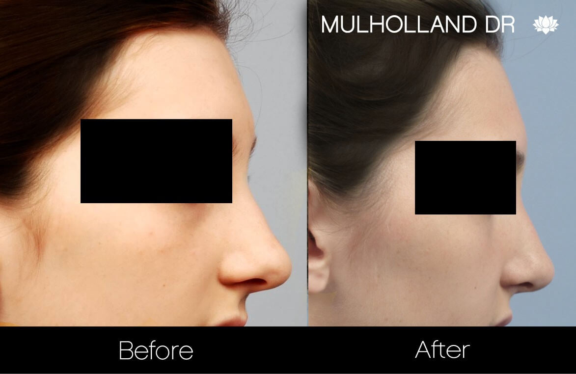 Rhinoplasty - Before and After Gallery – Photo 20