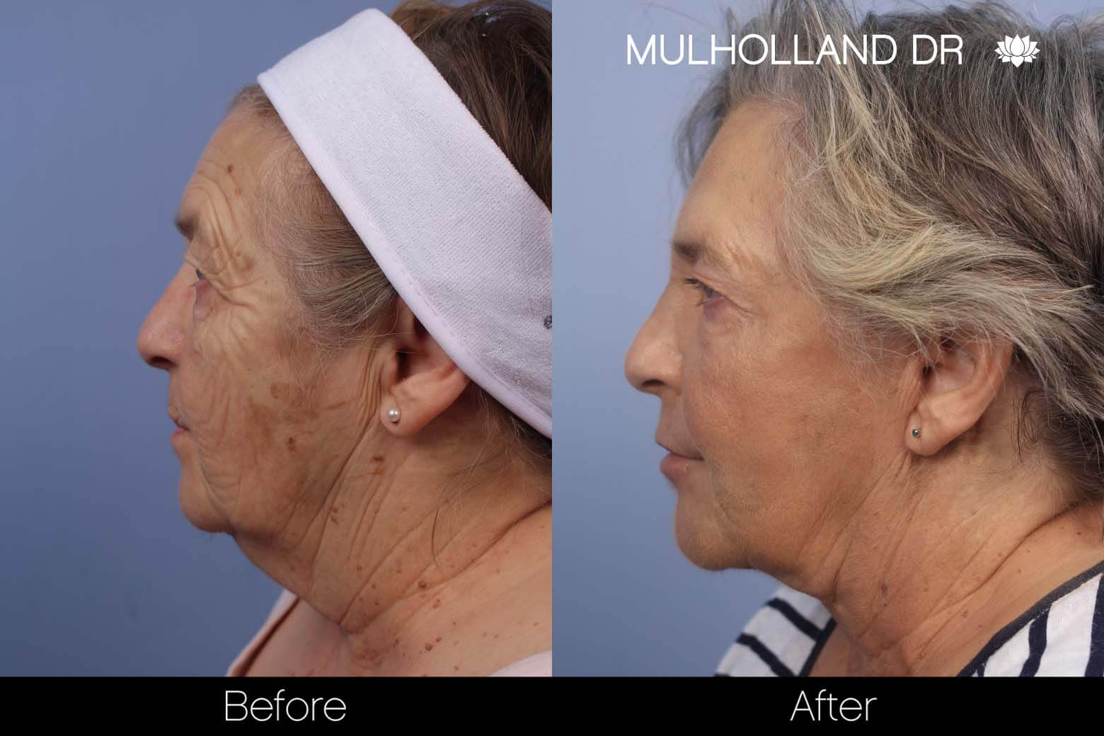 Facelift - Before and After Gallery – Photo 21