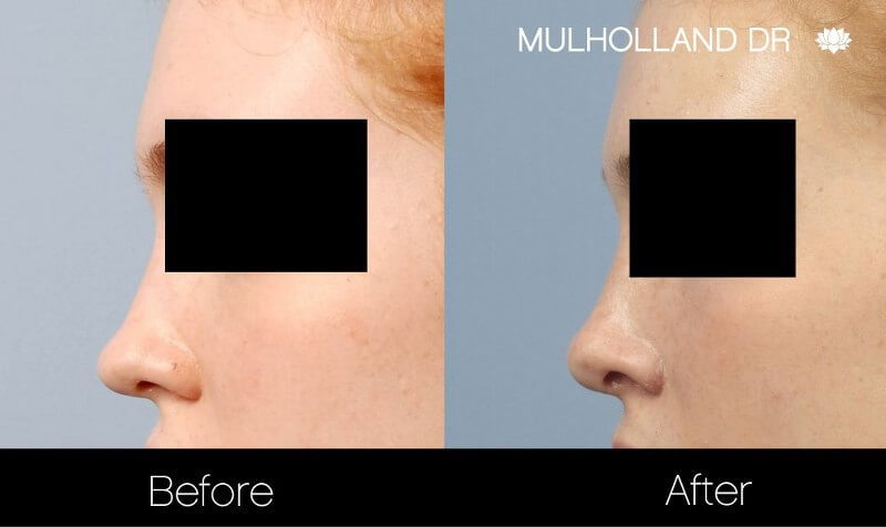 Rhinoplasty - Before and After Gallery – Photo 23