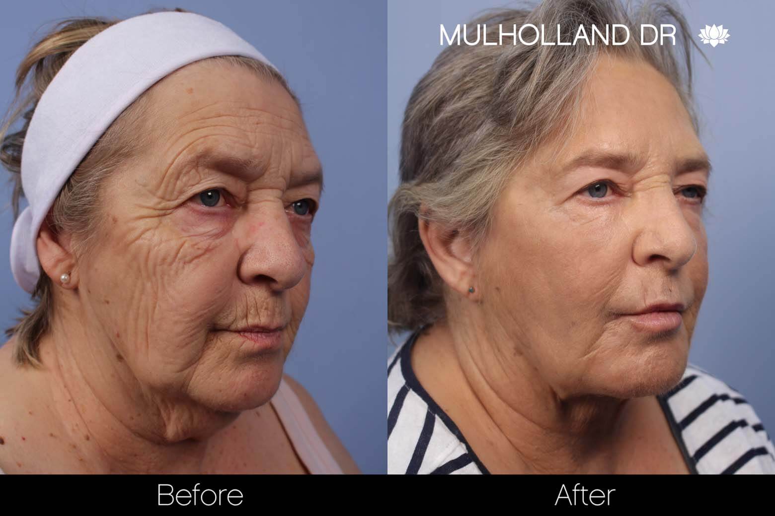 Facelift - Before and After Gallery – Photo 22