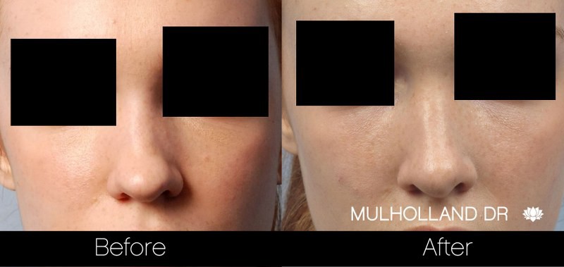 Rhinoplasty - Before and After Gallery – Photo 24