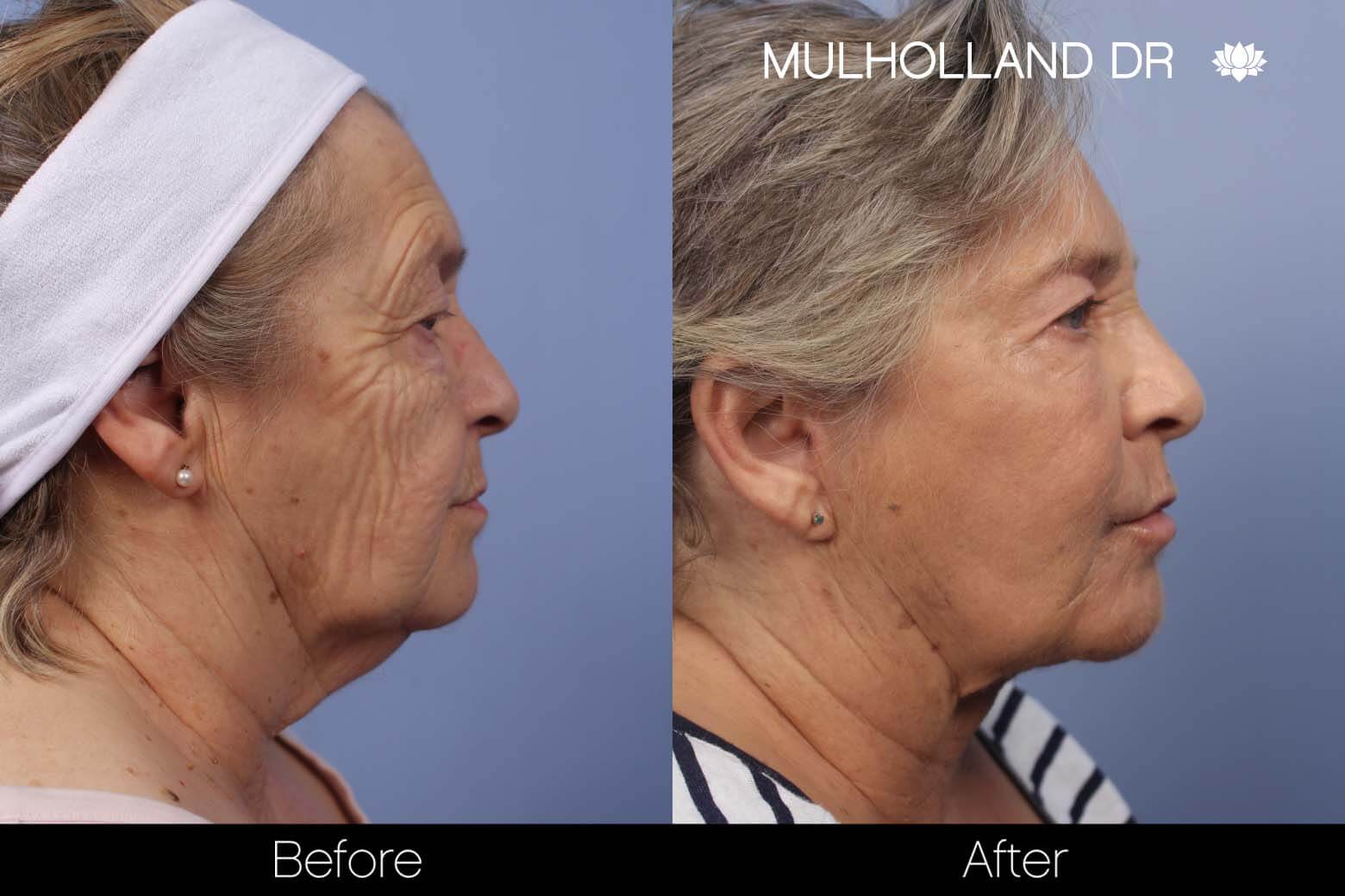 Facelift - Before and After Gallery – Photo 23