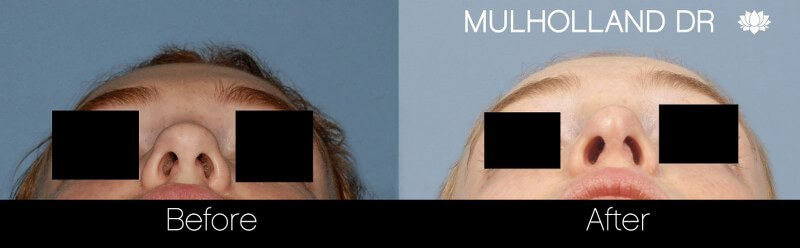 Rhinoplasty - Before and After Gallery – Photo 21