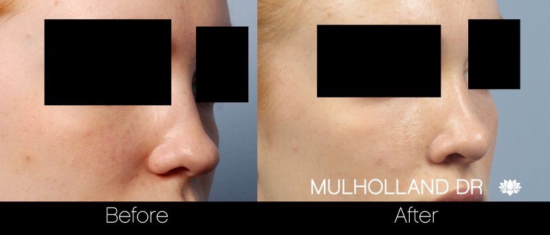 Rhinoplasty - Before and After Gallery – Photo 22