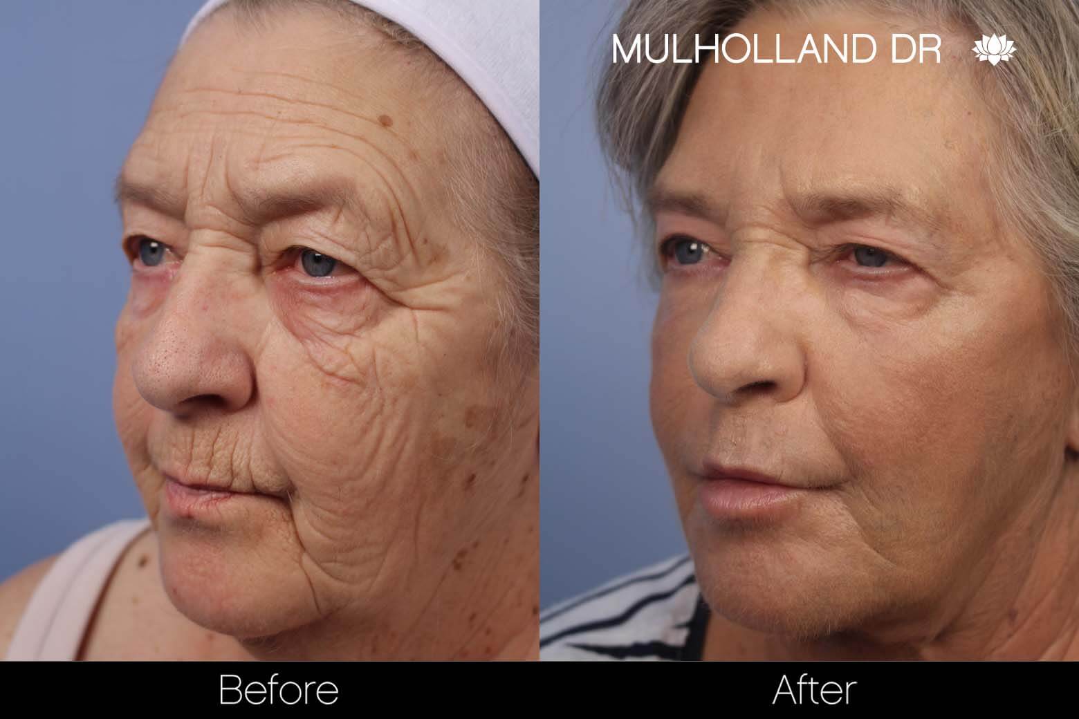 Facelift - Before and After Gallery – Photo 25