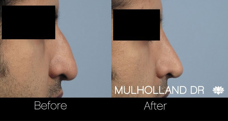 Rhinoplasty - Before and After Gallery – Photo 25