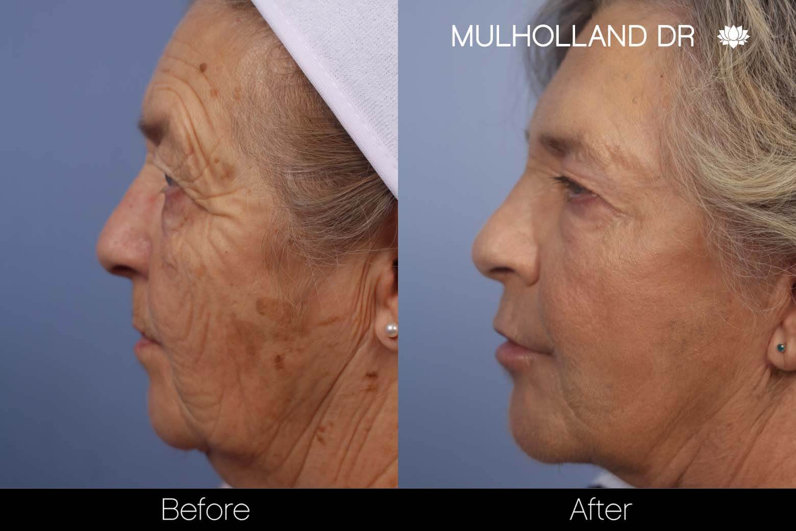 Facelift - Before and After Gallery – Photo 26