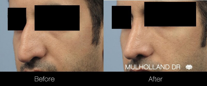 Rhinoplasty - Before and After Gallery – Photo 26