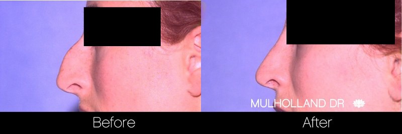 Rhinoplasty - Before and After Gallery – Photo 27