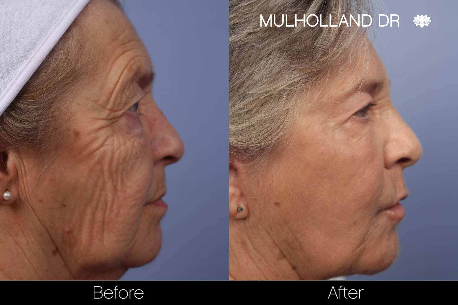 Facelift - Before and After Gallery – Photo 28